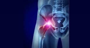 Fibromyalgia Lower Back and Hip Flexor Pain